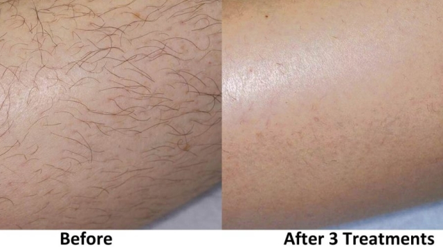 The Ultimate Guide to Smooth Skin: Mastering Laser Hair Removal