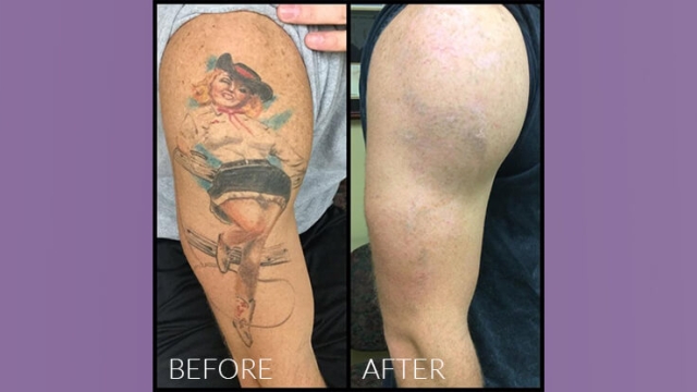 Tattoo Removal Made Easy With Laser Hair Treatment