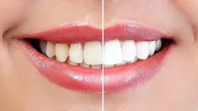 Smile Brighter: Unleashing the Magic of Teeth Whitening