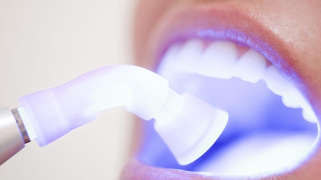 Sparkling Smiles: The Ultimate Guide to Teeth Whitening