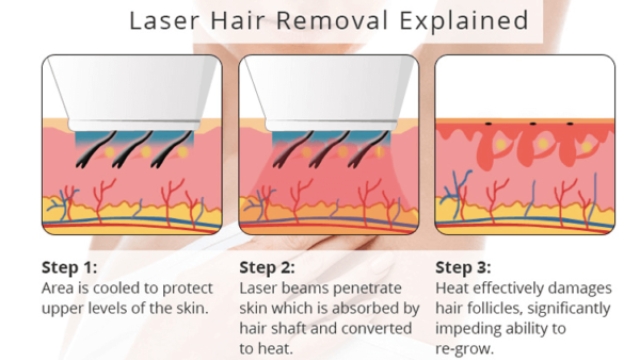 Smooth and Silky: Unveiling the Benefits of Laser Hair Removal